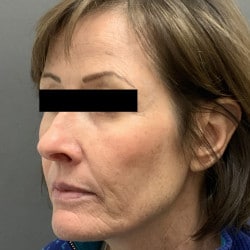 After Image: Laser Resurfacing by Dr. Thompson - left-front-oblique