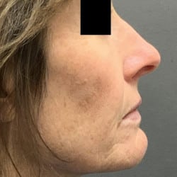 After Image: Laser Resurfacing by Dr. Thompson - right-side