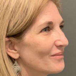 After Image: Laser Resurfacing by Dr. Henstrom - right-front-oblique