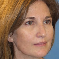 Before Image: Laser Resurfacing by Dr. Henstrom - right-front-oblique