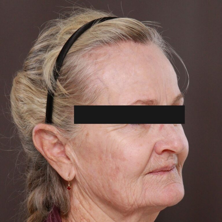 Before Image: Contour TRL with Katy Larson - right-front-oblique