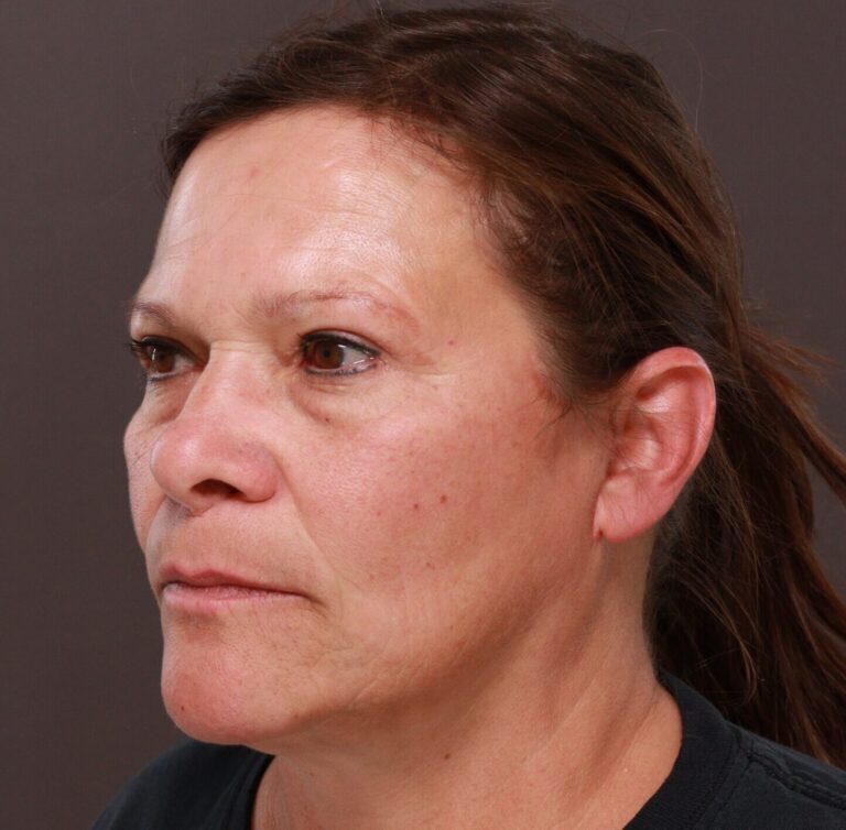 After Image: MACSlift and Upper Blepharoplasty by Dr. Henstrom - left-front-oblique