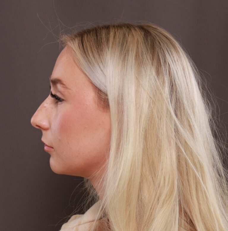 Before Image: Rhinoplasty by Dr. Henstrom - left-side