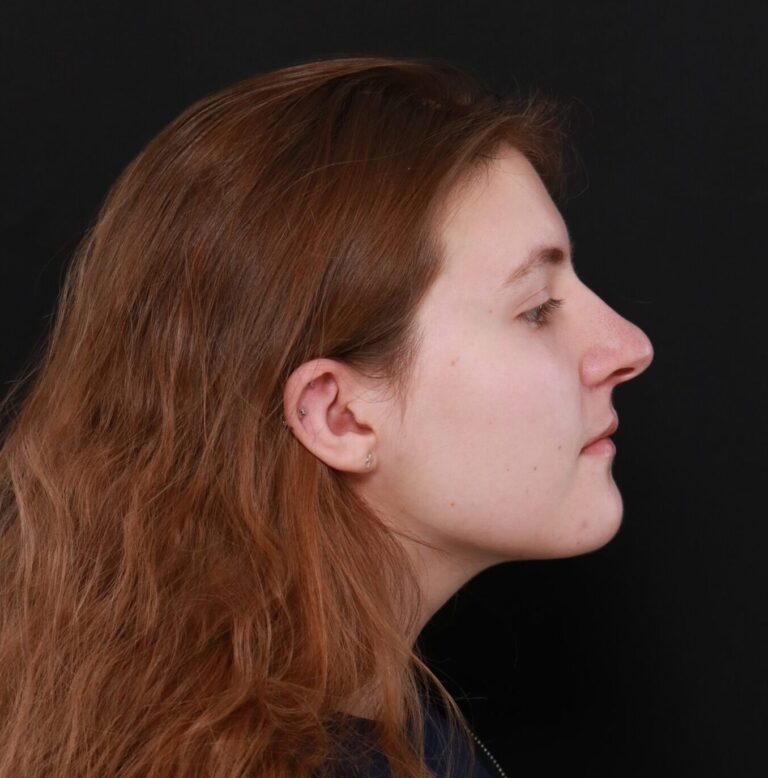 Before Image: Rhinoplasty by Dr. Thompson - right-side