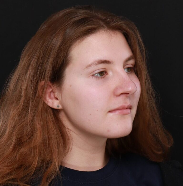 Before Image: Rhinoplasty by Dr. Thompson - right-front-oblique