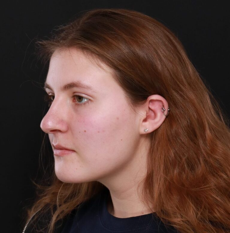 Before Image: Rhinoplasty by Dr. Thompson - left-front-oblique