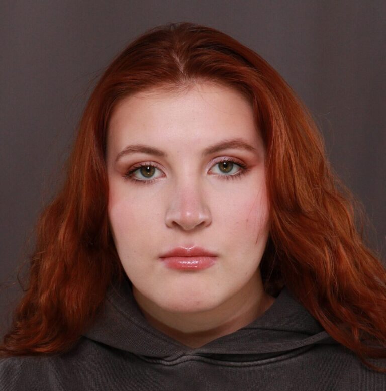 After Image: Rhinoplasty by Dr. Thompson - front