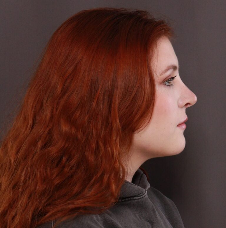 After Image: Rhinoplasty by Dr. Thompson - right-side