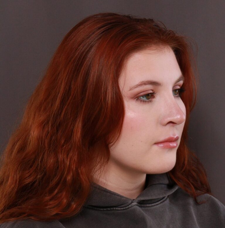 After Image: Rhinoplasty by Dr. Thompson - right-front-oblique