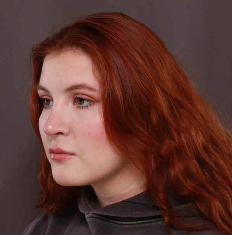After Image: Rhinoplasty by Dr. Thompson - left-front-oblique