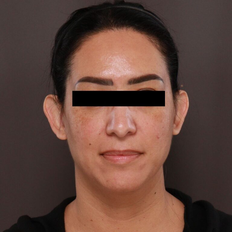 Before Image: Otoplasty by Dr. Henstrom - front