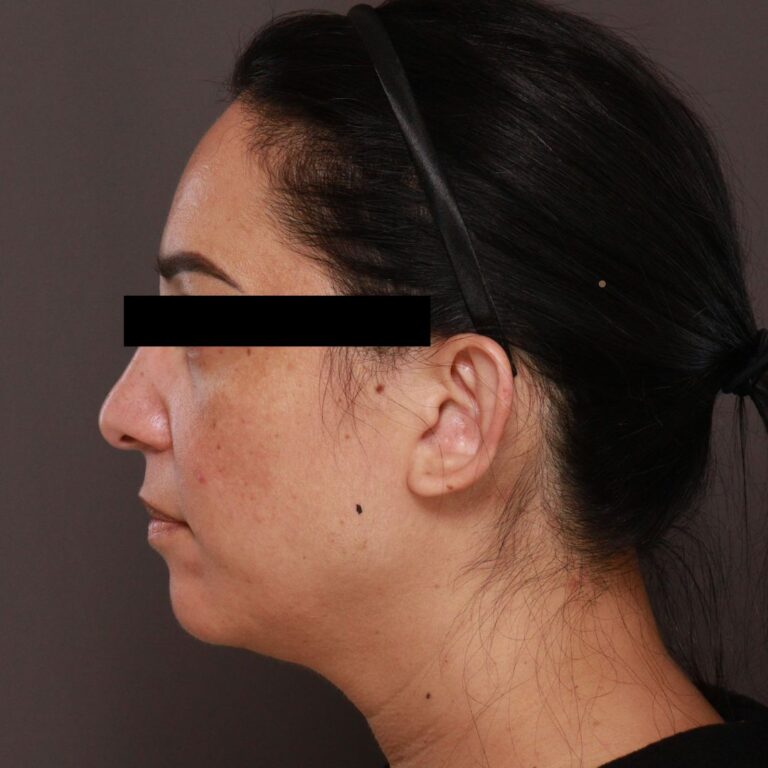 Before Image: Otoplasty by Dr. Henstrom - left-side