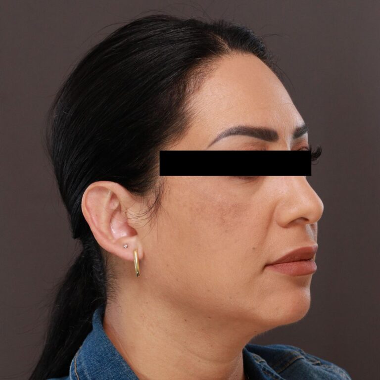 After Image: Otoplasty by Dr. Henstrom - right-front-oblique