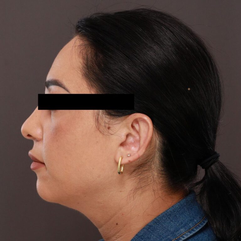 After Image: Otoplasty by Dr. Henstrom - left-side