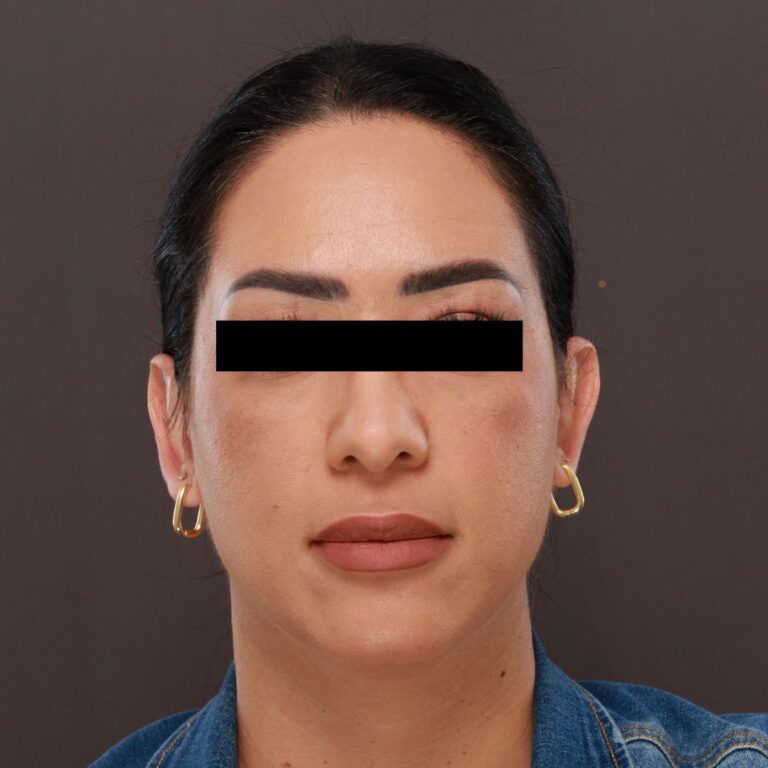 After Image: Otoplasty by Dr. Henstrom - front