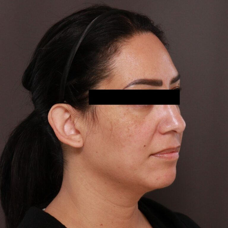 Before Image: Otoplasty by Dr. Henstrom - right-front-oblique