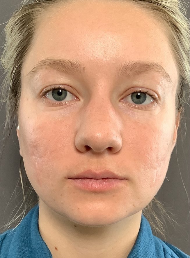 Before Image: Halo and BBL Laser Resurfacing by: Katy - front