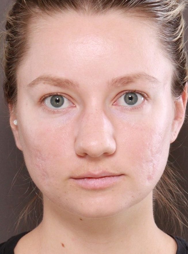 After Image: Halo and BBL Laser Resurfacing by: Katy - front
