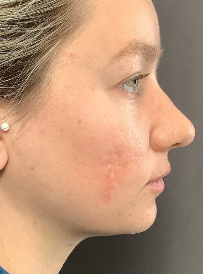 Before Image: Halo and BBL Laser Resurfacing by: Katy - right-side