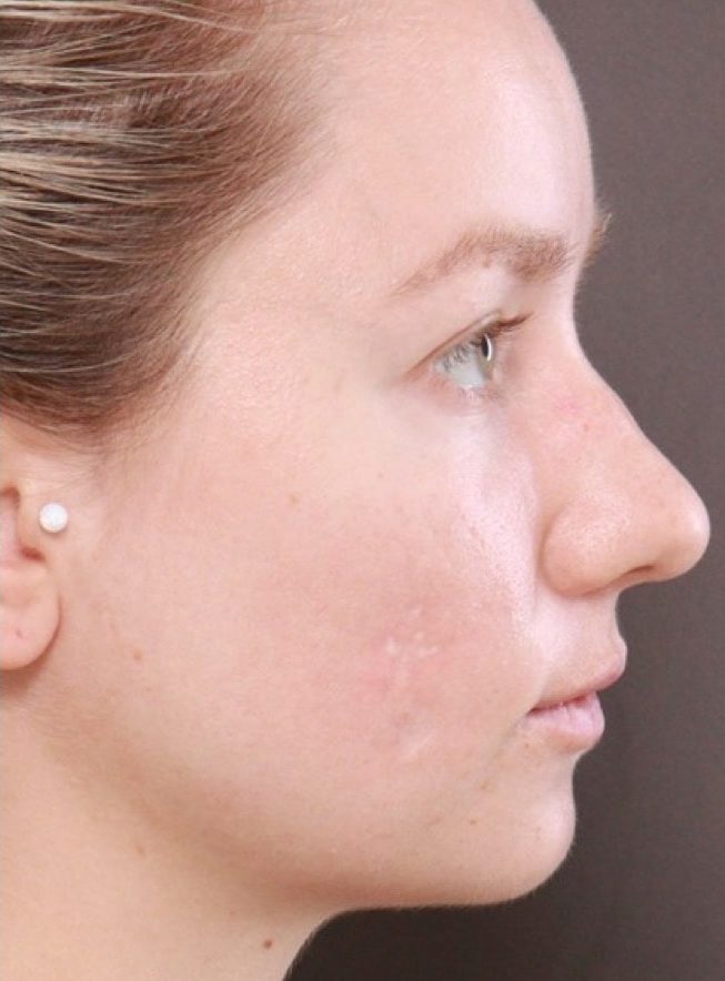 After Image: Halo and BBL Laser Resurfacing by: Katy - right-side