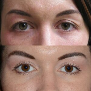 Upper Blepharoplasty Aesthetic