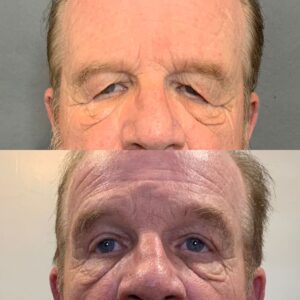 Upper Blepharoplasty Functional