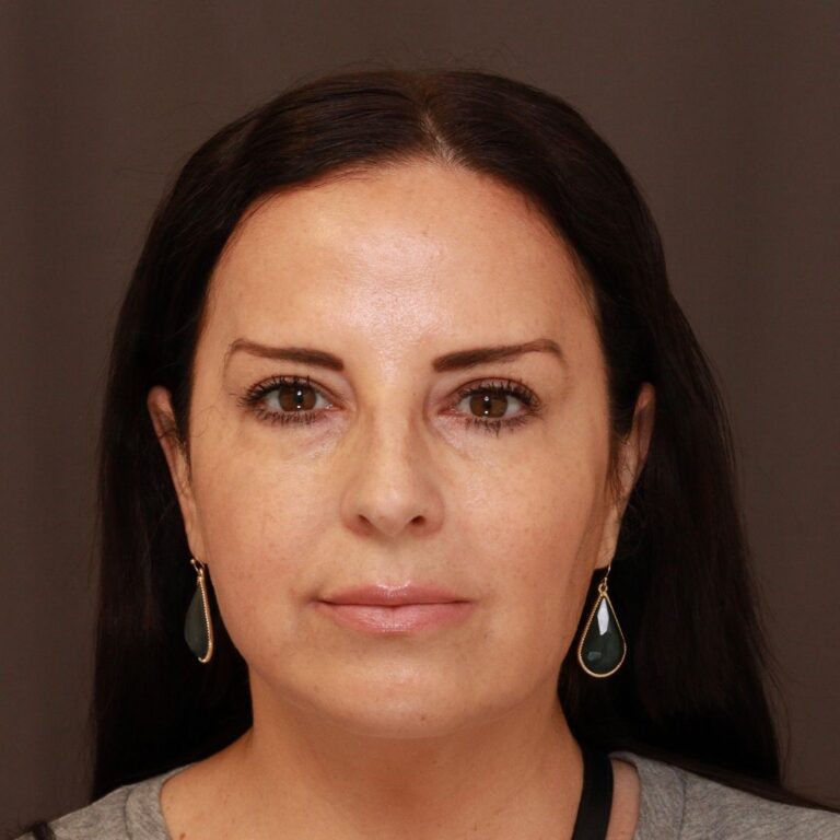 Before Image: Botox and Filler - front