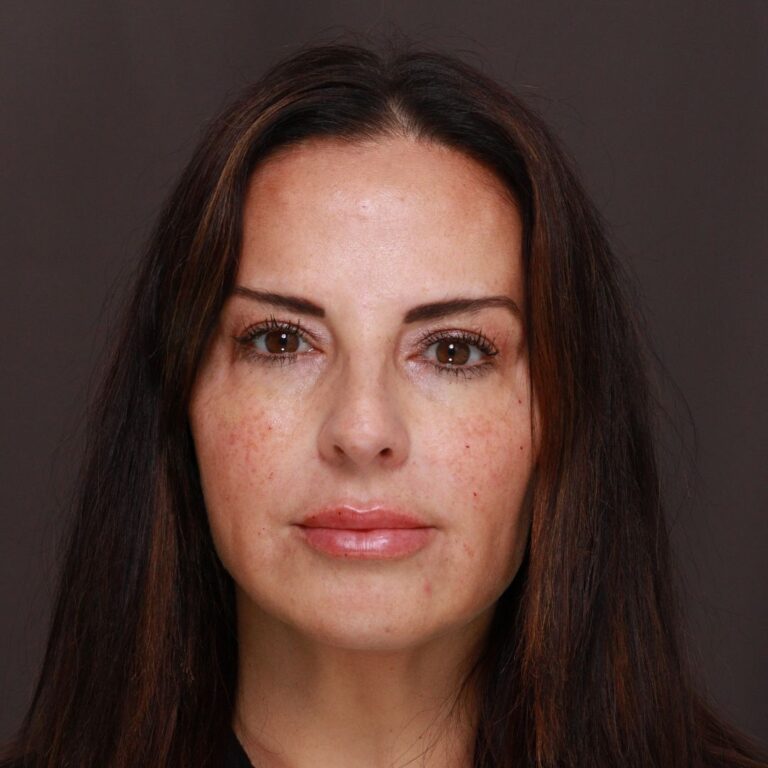 After Image: Botox and Filler - front