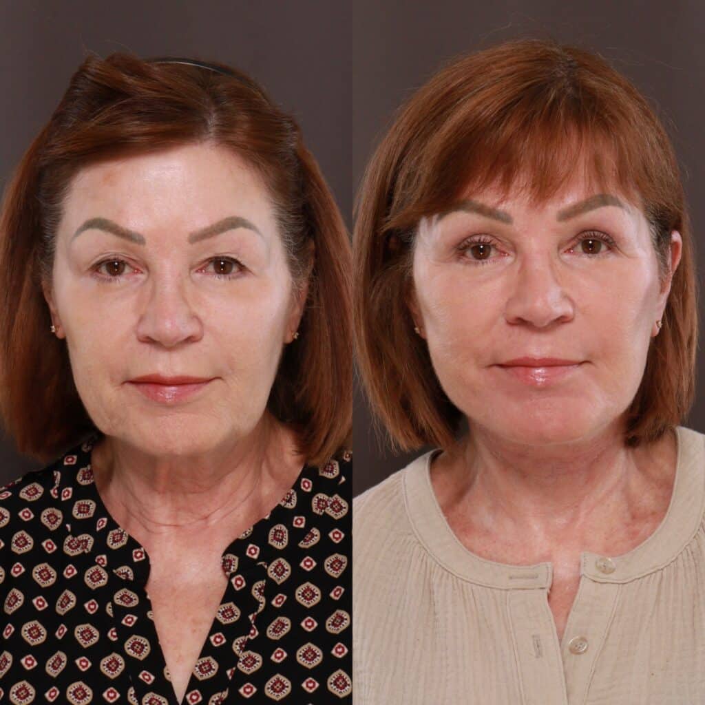 Periorbital Fat Grafting (Facelift, Bleph, Contour TRL) 
