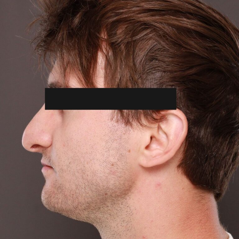 Before Image: Rhinoplasty by Dr. Thompson - left-side