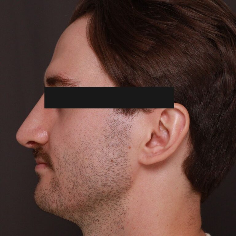 After Image: Rhinoplasty by Dr. Thompson - left-side