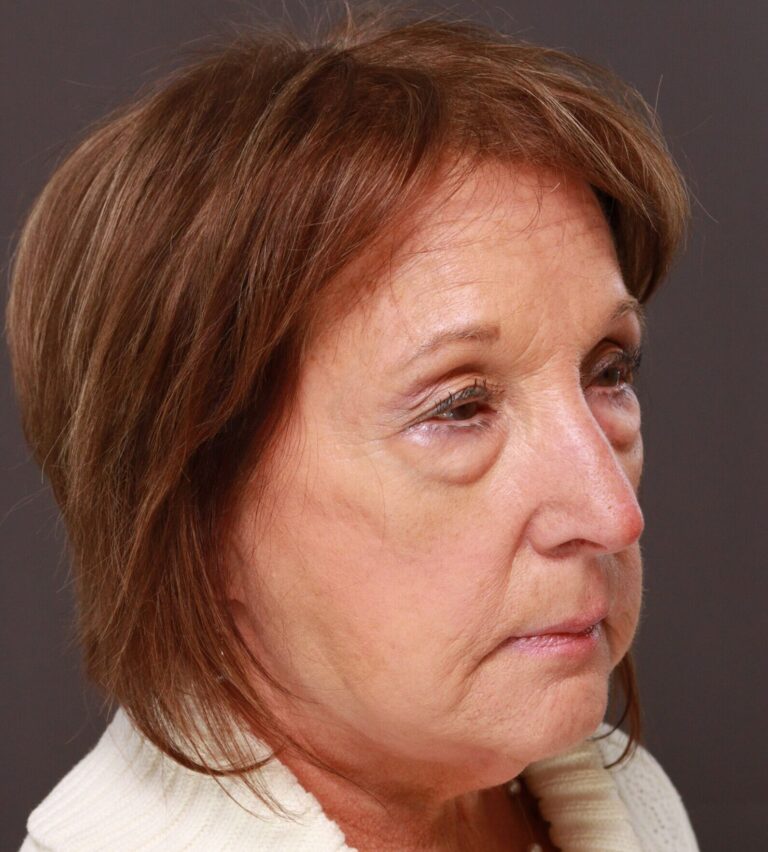 Before Image: Upper and Lower Blepharoplasty by Dr. Henstrom - right-front-oblique