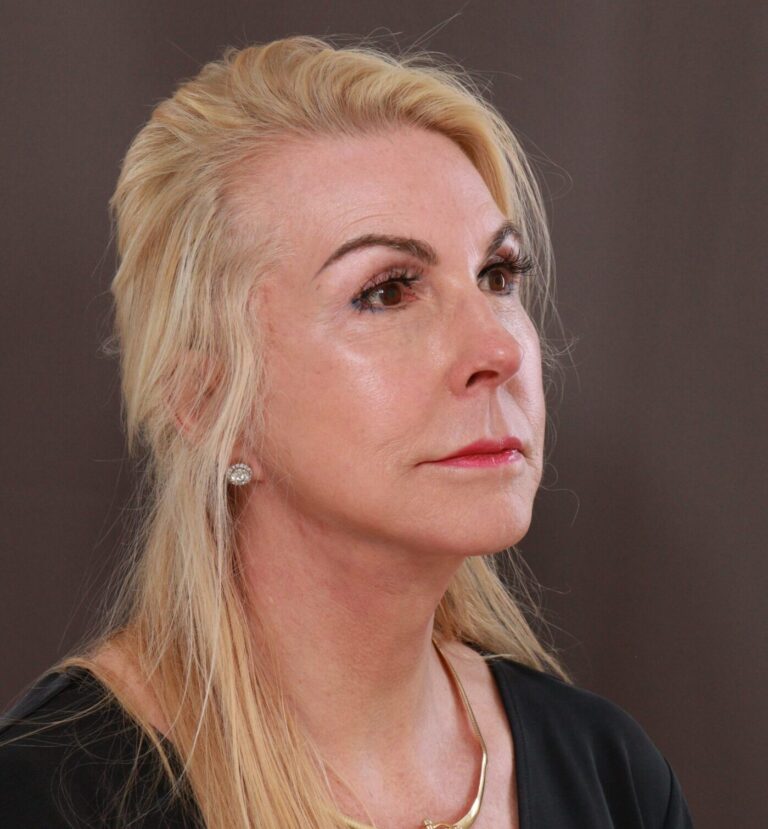 After Image: Facelift by Dr. Henstrom - front