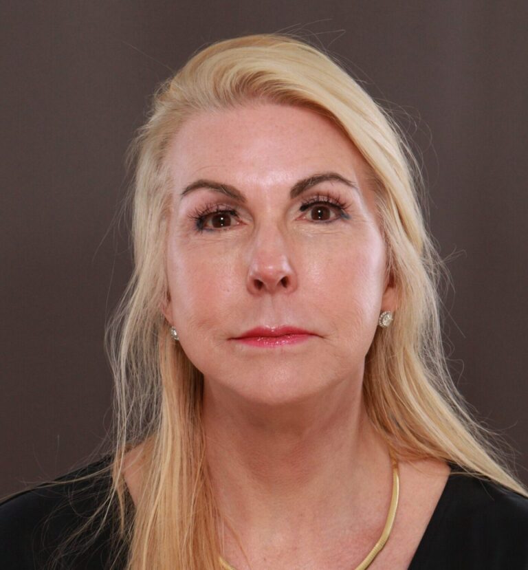 After Image: Facelift by Dr. Henstrom - front