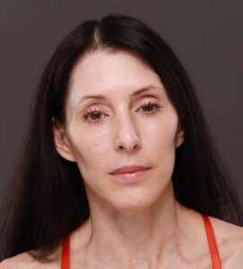 After Image: Revision Facelift and Fat Grafting by Dr. Thompson