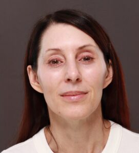 Before Image: Revision Facelift and Fat Grafting by Dr. Thompson