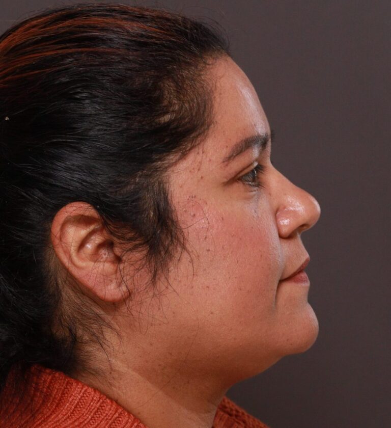 After Image: Upper Blepharoplasty by Dr. Manning - right-side