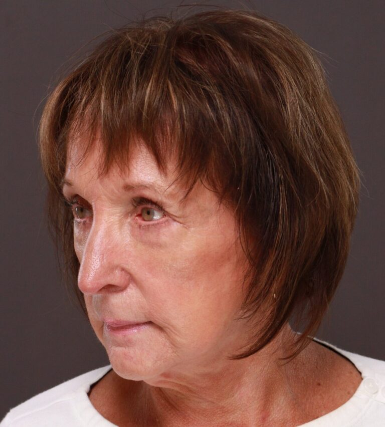 After Image: Upper and Lower Blepharoplasty by Dr. Henstrom - left-front-oblique