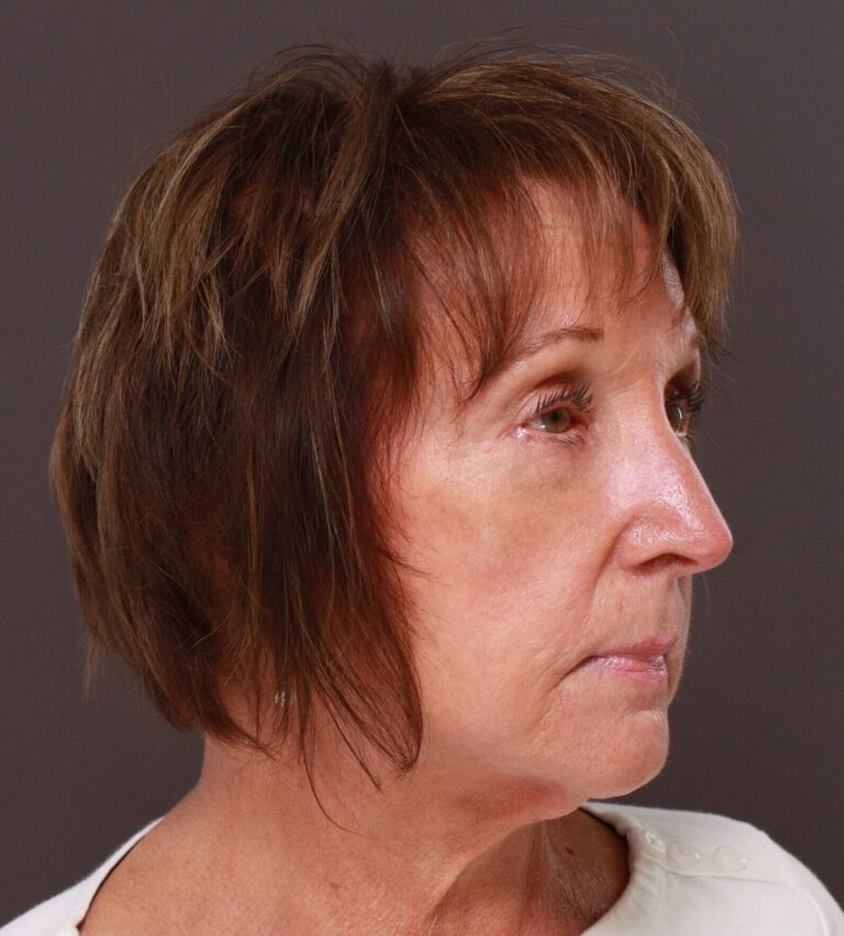 After Image: Upper and Lower Blepharoplasty by Dr. Henstrom - right-front-oblique