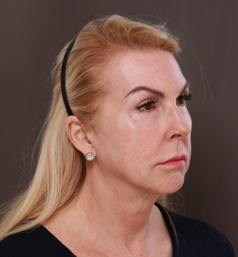Before Image: Facelift by Dr. Henstrom - front