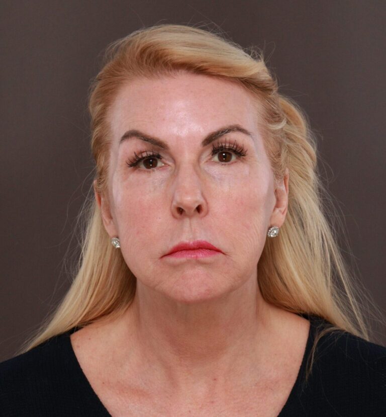 Before Image: Facelift by Dr. Henstrom - front