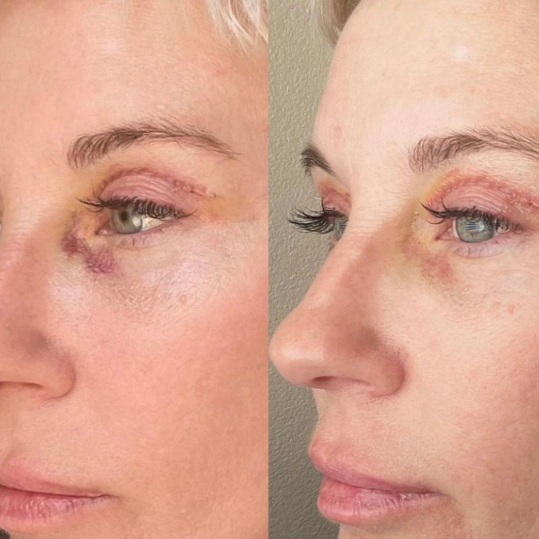 BBL bruising BBL bruising