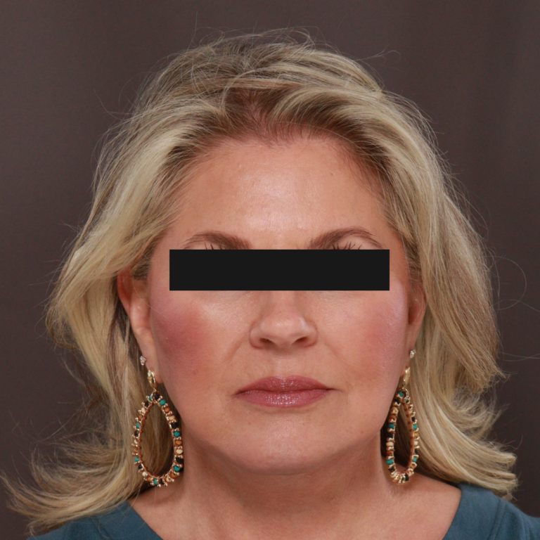 After Image: Revision Facelift & Earlobe Repair by Dr. Thompson - front