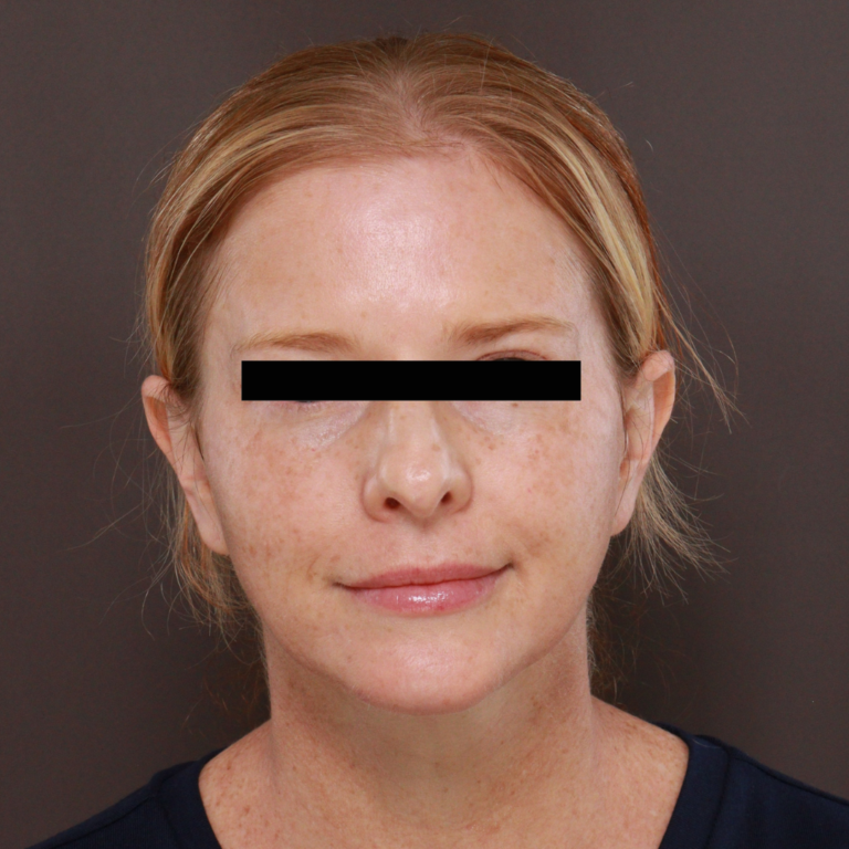 Before Image: Halo and BBL by Katy Larson - front