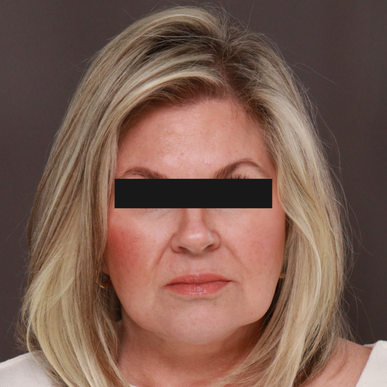 Before Image: Revision Facelift & Earlobe Repair by Dr. Thompson - front