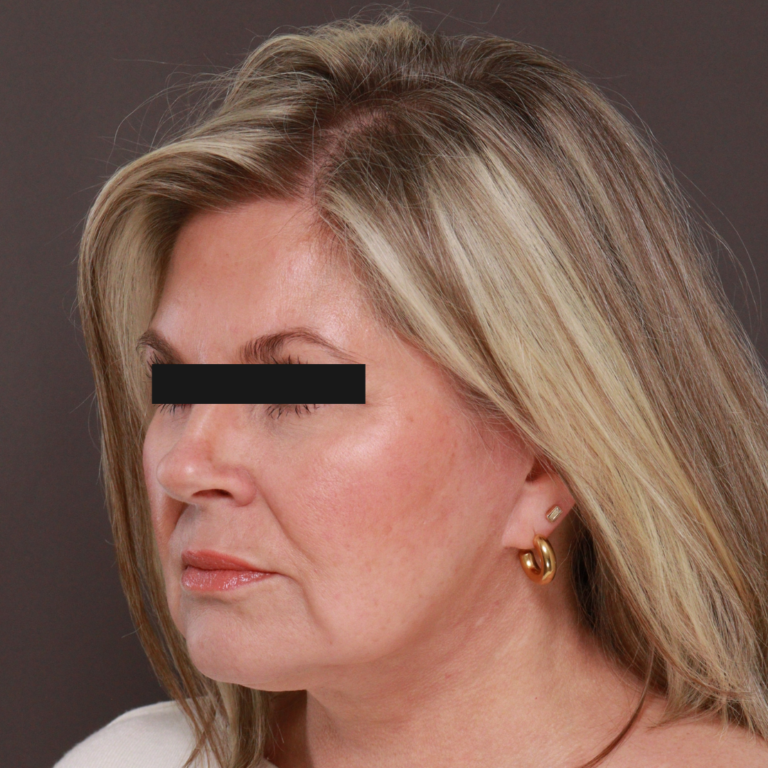 Before Image: Revision Facelift & Earlobe Repair by Dr. Thompson - front