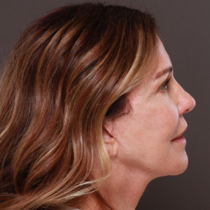 After Image: Revision Facelift by Dr. Henstrom