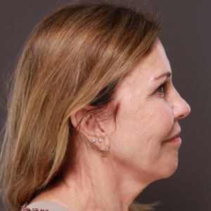 Before Image: Revision Facelift by Dr. Henstrom