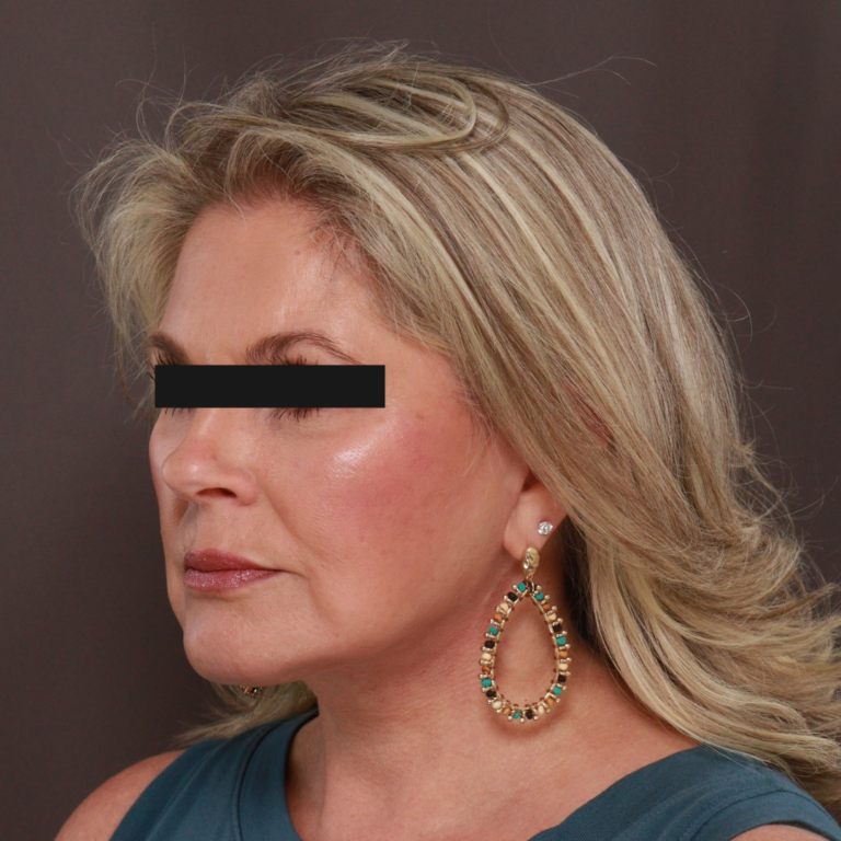 After Image: Revision Facelift & Earlobe Repair by Dr. Thompson - front