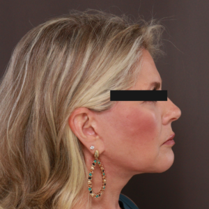 After Image: Revision Facelift & Earlobe Repair by Dr. Thompson
